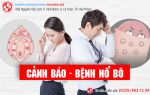 Bệnh nổ bô căn bệnh nguy hiểm dễ lây nhiễm ở nam và nữ