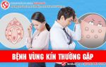 Điểm danh các bệnh vùng kín thường gặp ở cả nam và nữ