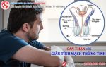 Giãn tĩnh mạch thừng tinh - Cẩn thận nguy cơ vô sinh