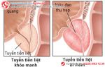 Chữa viêm tuyến tiền liệt hiệu quả