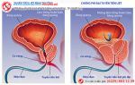 Nam giới và nỗi lo phì đại tuyến tiền liệt