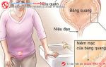 Chồng qua đêm với nhân tình, vợ bị mắc viêm đường tiết niệu nữ