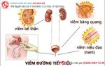 Hiểu đúng về cách chữa viêm đường tiết niệu