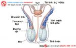 Nguy cơ vô sinh hiếm muộn do viêm túi tinh