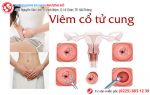 Phát hiện, điều trị sớm viêm cổ tử cung phòng tránh nguy cơ ung thư