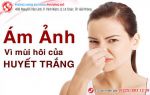 Nguyên nhân khí hư có mùi hôi và cách điều trị hiệu quả