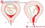 [Cảnh báo] Nguy hiểm ra sao khi bị sót nhau thai?