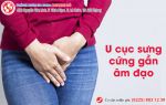 U cục sưng cứng gần âm đạo – Triệu chứng của viêm tuyến Bartholin