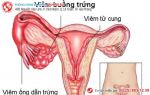 Hiểu đúng bệnh, chữa đúng cách khi bị viêm buồng trứng