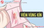 Viêm vùng kín – Nỗi khổ tâm của chị em phụ nữ