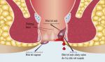 Các dấu hiệu bệnh trĩ và cách khám chữa hiệu quả