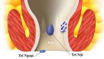 Búi Trĩ sa ra ngoài: Triệu chứng và cách hỗ trợ chữa trị hiệu quả