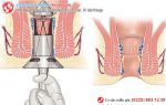 Cắt Trĩ Bằng Phương Pháp Longo Có Tốt Không?