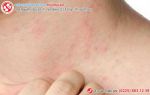 Nhận biết sớm các giai đoạn bệnh giang mai