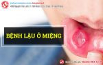 Mắc bệnh lậu ở miệng do trót “yêu” bằng thế “lạ”