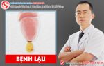 Hơn 90% dương vật chảy dịch chảy nước do mắc bệnh lậu