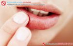 Bị sùi mào gà ở miệng vì quan hệ với trai trẻ