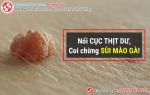 Nổi cục thịt dư, tỷ lệ mắc sùi mào gà cao