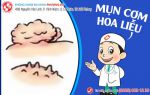 Mụn cơm hoa liễu là gì?