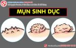 Nổi mụn sinh dục – chớ làm bừa