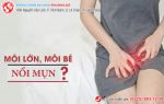 Nổi mụn môi lớn môi bé có đơn giản do thói quen xấu hàng ngày?