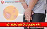 Chớ chủ quan với biến chứng từ sùi mào gà dương vật