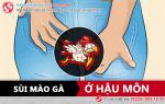 Sùi mào gà ở hậu môn – nỗi đau không biết chia sẻ cùng ai