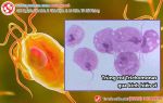 Bị nhiễm trichomonas – Đừng nên chủ quan!