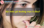 Vị trí sùi mào gà thường mọc ở đâu?