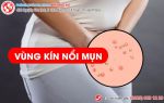 Liên tục nổi mụn môi lớn môi bé, đi khám mới “tá hỏa” nhiều bệnh