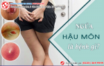 Ngứa Hậu Môn Và Cách Điều Trị Hiệu Quả Hiện Nay