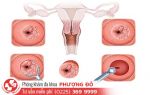 Cổ tử cung sừng hóa là gì?