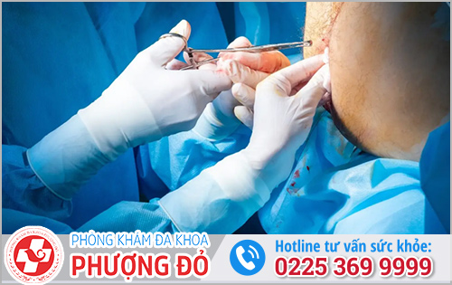 Cắt polyp hậu môn có đau hay nguy hiểm không?