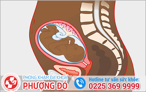 Mọi Thông Tin Về Phá Thai 24 Tuần Chị Em Cần Biết Rõ