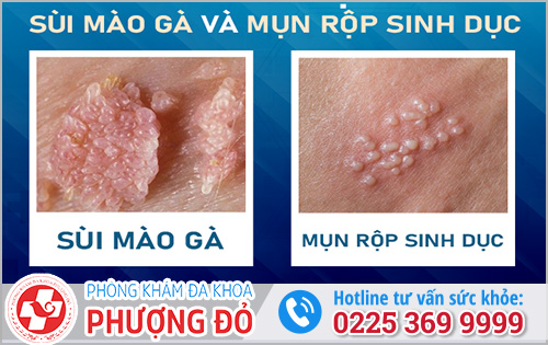 Sùi Mào Gà Và Mụn Rộp Sinh Dục: Làm sao phân biệt?