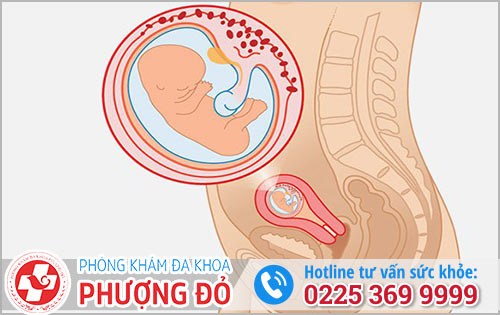 Phá Thai 21 Tuần Có Nguy Hiểm Không?