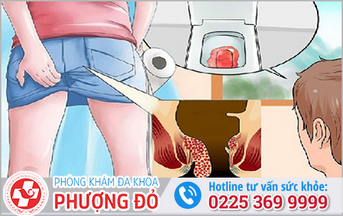 Biến Chứng Của Bệnh Trĩ Là Gì?