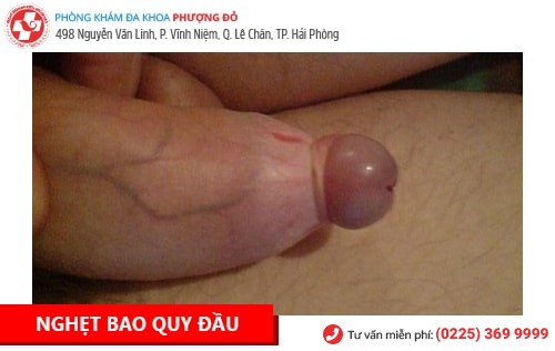  Hình ảnh bao quy đầu bình thường ở người lớn: Nhận biết và Phân biệt