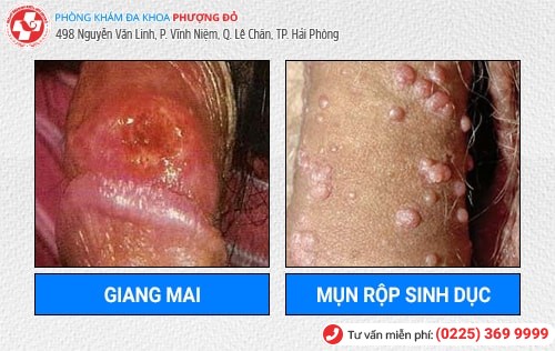 Bệnh Dương Vật Là Gì? Cách Chữa Trị Hiệu Quả Hiện Nay Bệnh Dương Vật Là Gì? Cách Chữa Trị Hiệu Quả Hiện Nay