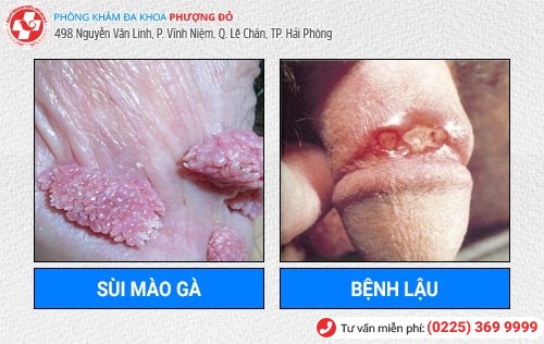 Bệnh Dương Vật Là Gì? Cách Chữa Trị Hiệu Quả Hiện Nay Bệnh Dương Vật Là Gì? Cách Chữa Trị Hiệu Quả Hiện Nay
