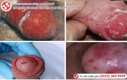bệnh ở bao quy đầu