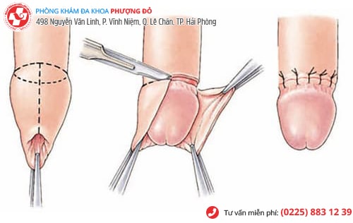 Hình ảnh bao quy đầu sau khi cắt Hình ảnh bao quy đầu sau khi cắt