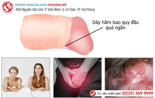 Dây hãm quy đầu bị ngắn có biểu hiện nào? Nguy hiểm không? Dây hãm quy đầu bị ngắn có biểu hiện nào? Nguy hiểm không?