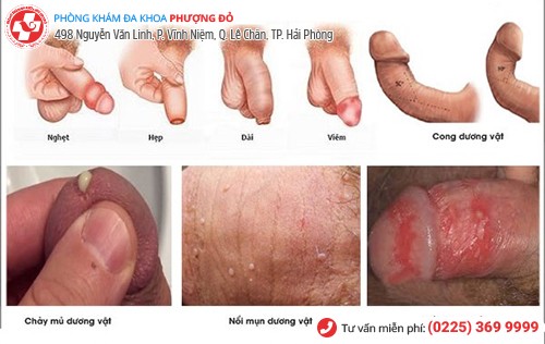 biểu hiện bệnh dương vật