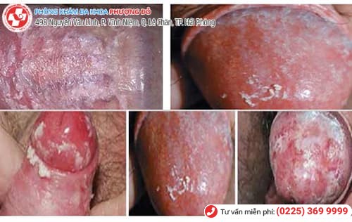biểu hiện nấm dương vật