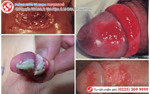 biểu hiện viêm bao quy đầu