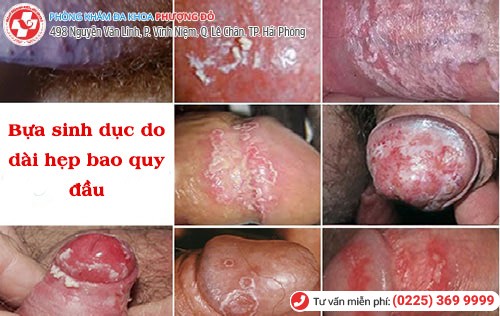 Bựa sinh dục – suýt hỏng dương vật vì lười vệ sinh Bựa sinh dục – suýt hỏng dương vật vì lười vệ sinh