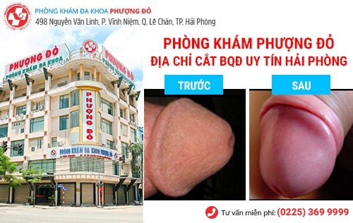 Cắt bao quy đầu mất bao nhiêu tiền? Giải đáp chi tiết từ bác sĩ chuyên khoa Cắt bao quy đầu mất bao nhiêu tiền? Giải đáp chi tiết từ bác sĩ chuyên khoa