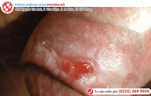 chảy máu dương vật