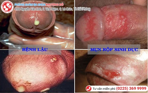 Nấm bao quy đầu – Khám ngay kẻo hối hận Nấm bao quy đầu – Khám ngay kẻo hối hận